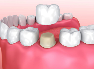 SINGLE CROWN (CAD/CAM)