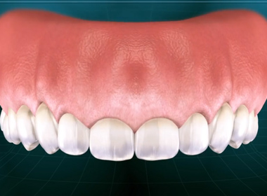 CROWN LENGTHENING (ESTHETIC)