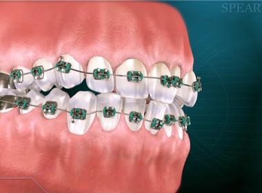 TRADITIONAL ORTHODONTICS
