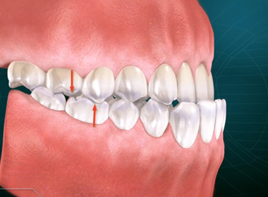 MALOCCLUSION (CLASS III)