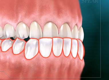MALOCCLUSION (CLASS I)