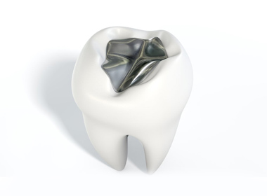 AMALGAM FILLING (POSTERIOR)