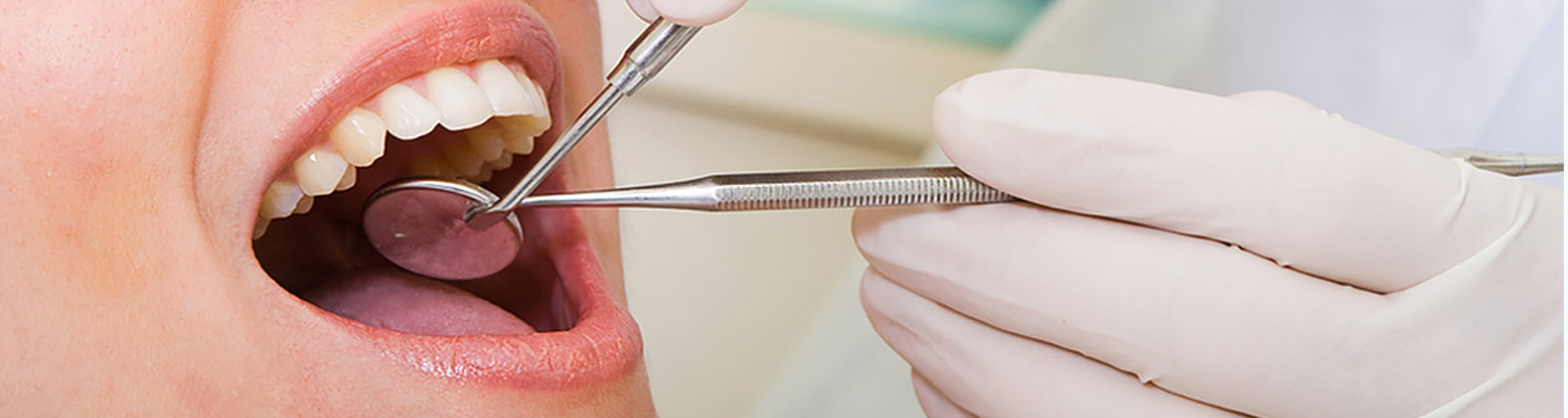 bonded-fillings