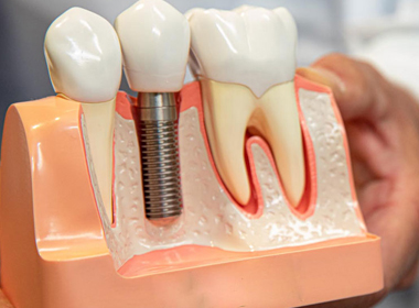 implant-restoration