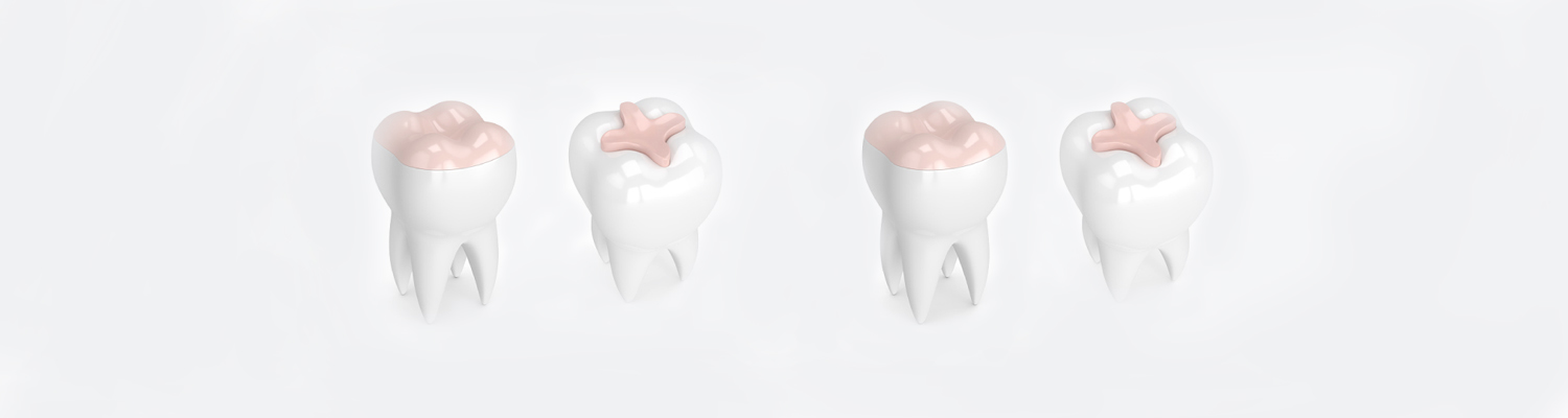 porcelain-inlays
