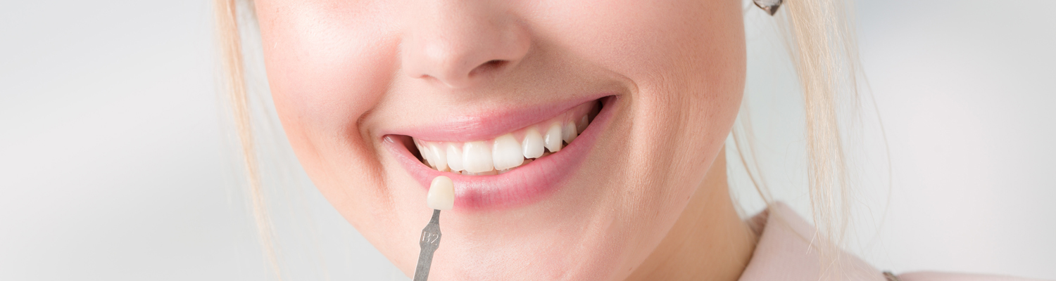 porcelain-veneers