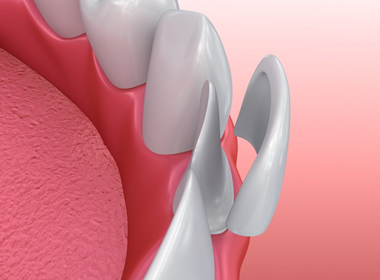 porcelain-veneers